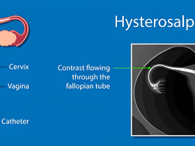 Hysterosalpingogram - Fertility Test for Tubal Patency